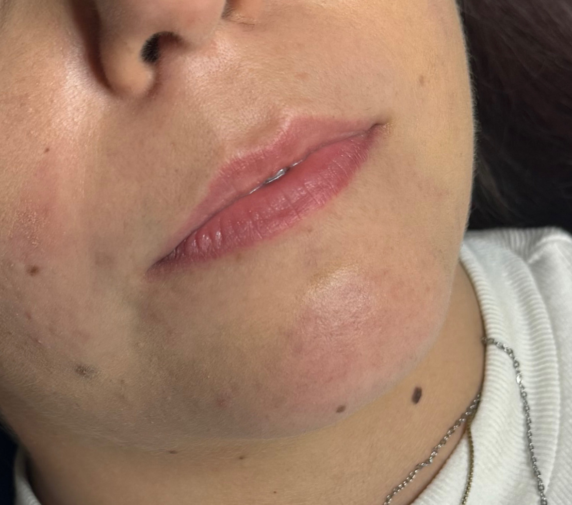 Labbra prima del trattamento con Metodo MP Lips — caso 1