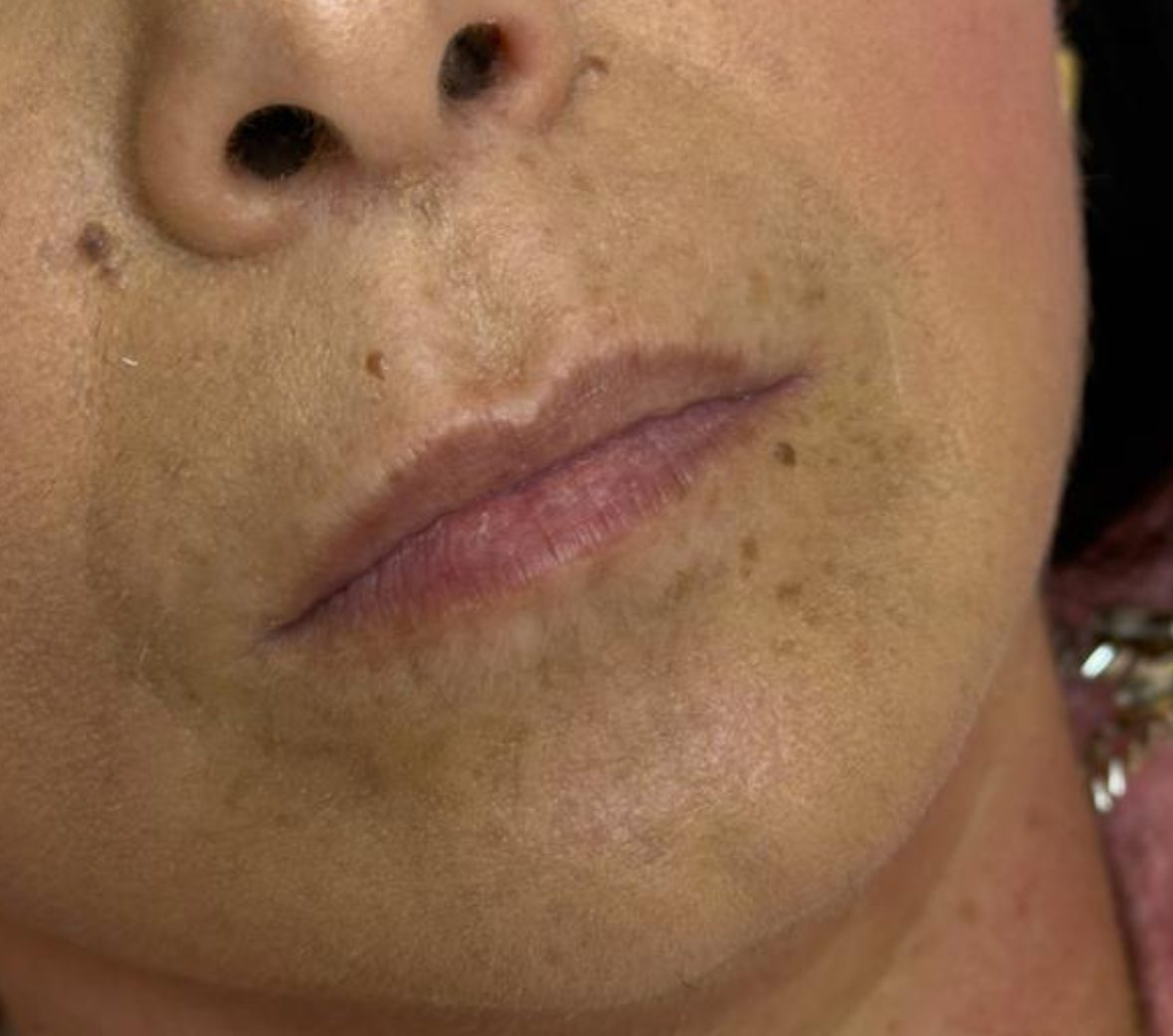 Labbra prima del trattamento con Metodo MP Lips — caso 2