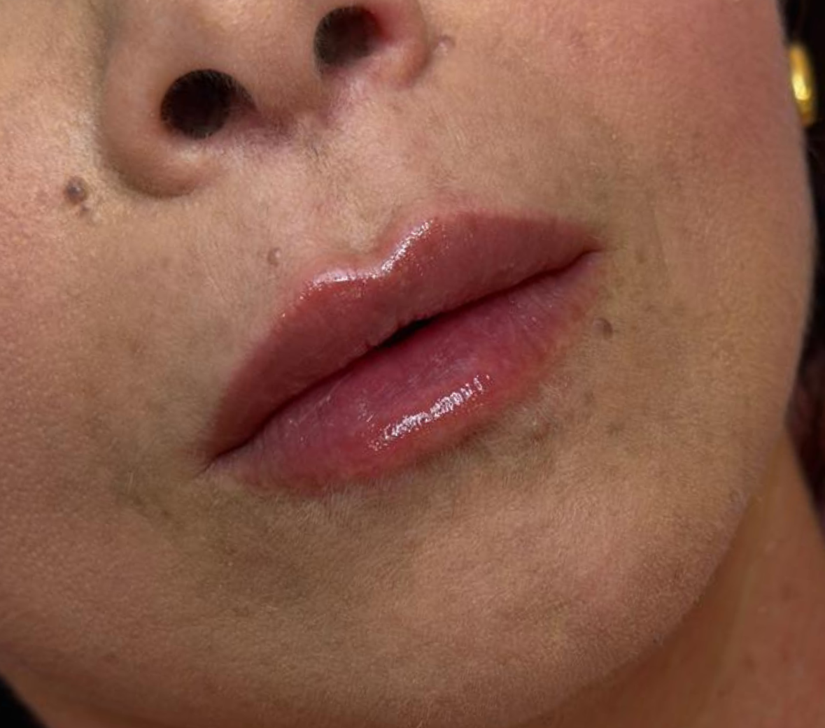 Labbra dopo il trattamento con Metodo MP Lips — caso 3