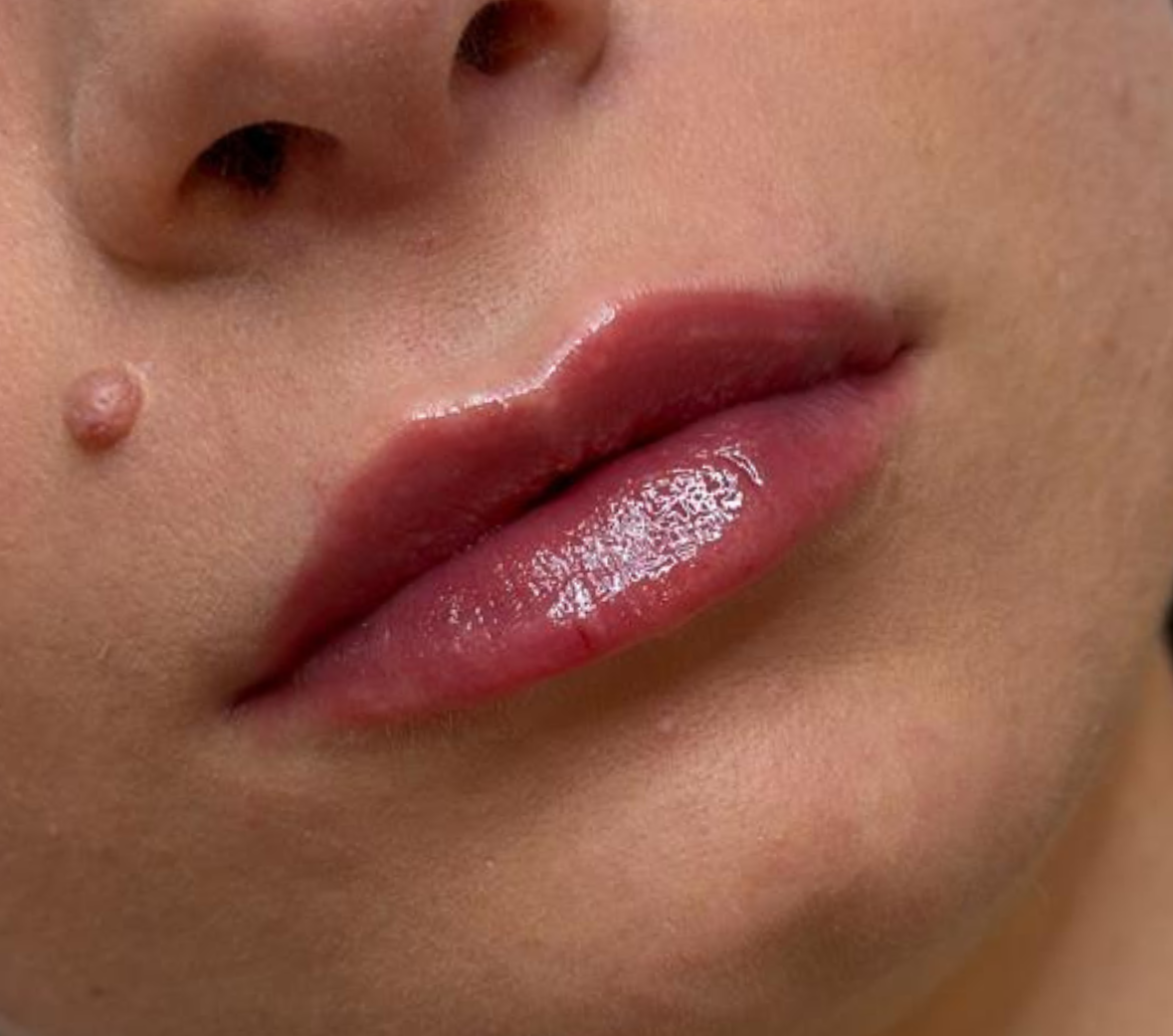 Labbra dopo il trattamento con Metodo MP Lips — caso 2