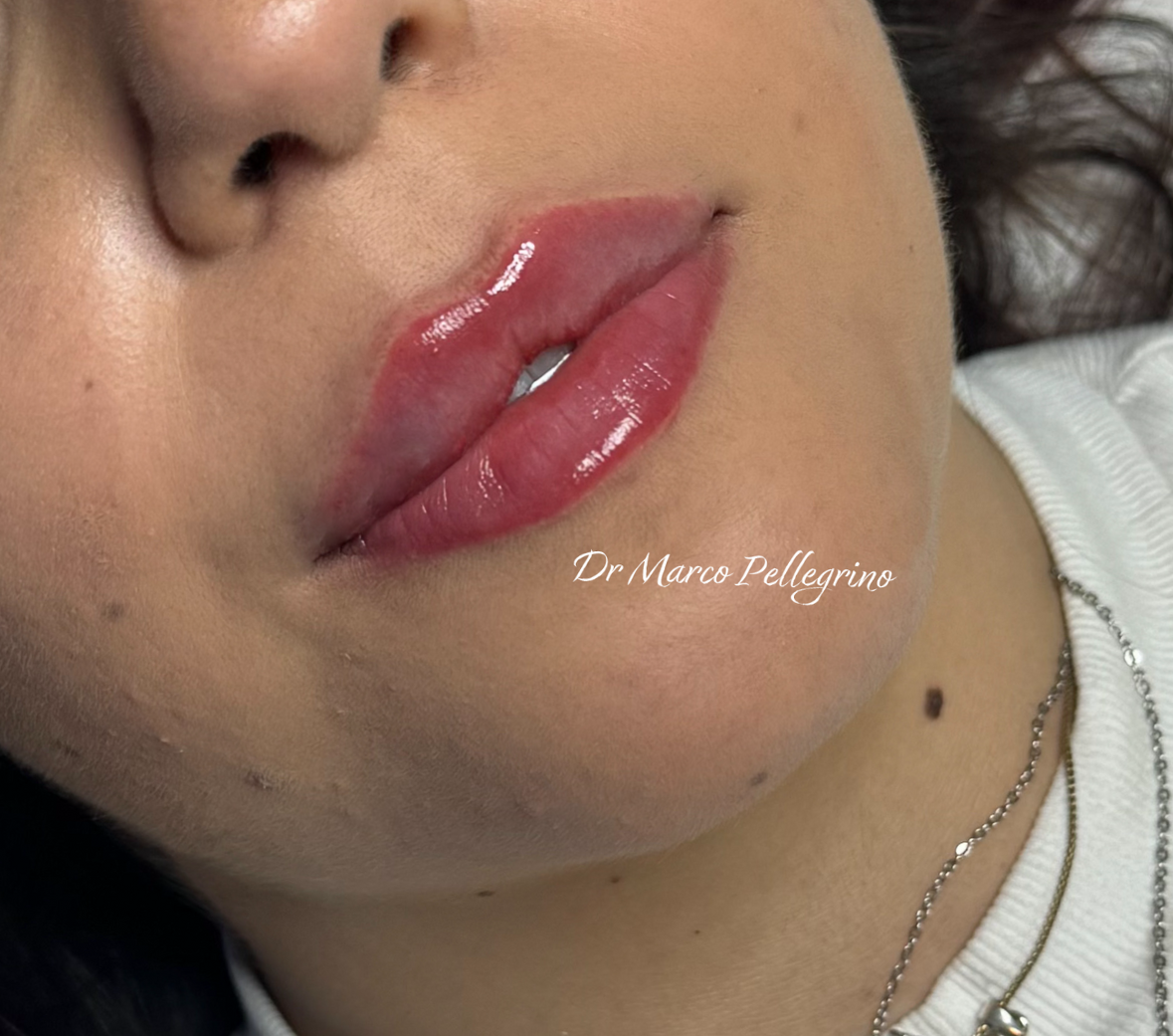 Labbra dopo il trattamento con Metodo MP Lips — caso 1